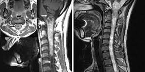 Glioma Surgery